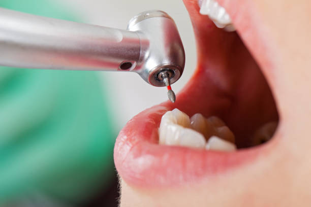 Best Emergency Dental Care for Broken or Chipped Teeth in Bismarck, MO